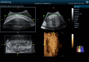 4D-визуализация позвоночника эмбриона
